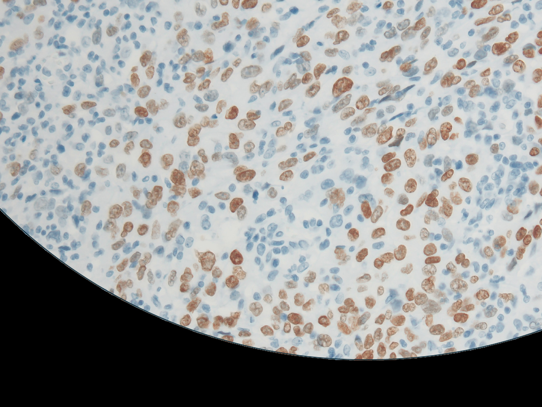 Identification of NovelBRCA2Mutations in Patients with Multiple Primary Lung Cancer